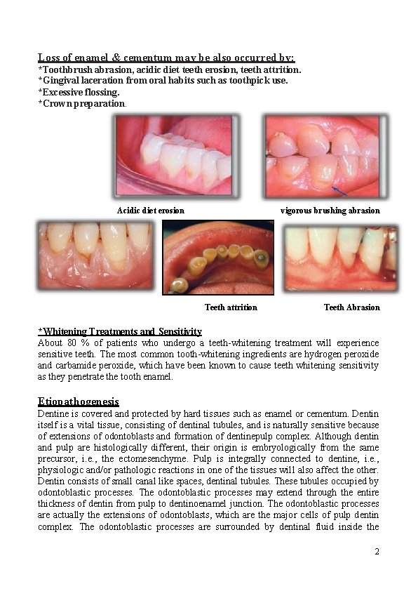 Loss of enamel & cementum may be also occurred by: *Toothbrush abrasion, acidic diet Loss of enamel & cementum may be also occurred by: *Toothbrush abrasion, acidic diet
