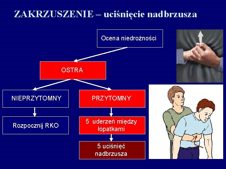 ZAKRZUSZENIE – uciśnięcie nadbrzusza Ocena niedrożności OSTRA NIEPRZYTOMNY Rozpocznij RKO 5 uderzeń między łopatkami