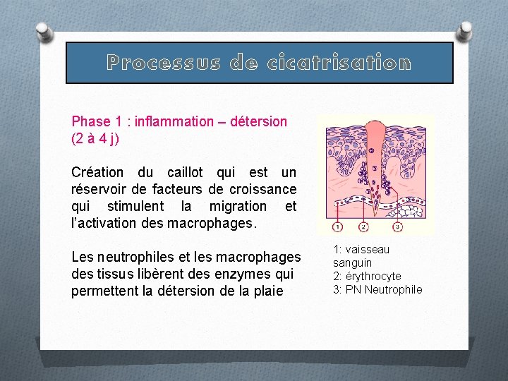Processus de cicatrisation Phase 1 : inflammation – détersion (2 à 4 j) Création Processus de cicatrisation Phase 1 : inflammation – détersion (2 à 4 j) Création