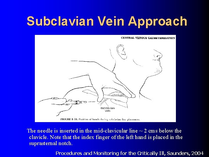 Subclavian Vein Approach The needle is inserted in the mid-clavicular line ~ 2 cms