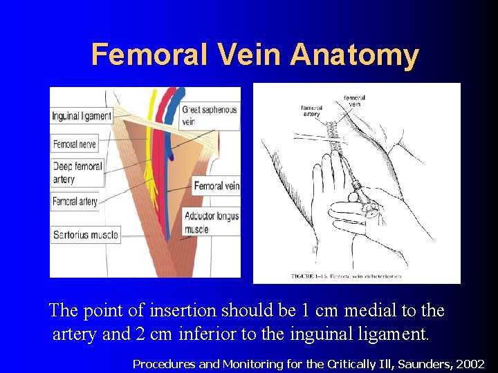 Femoral Vein Anatomy The point of insertion should be 1 cm medial to the