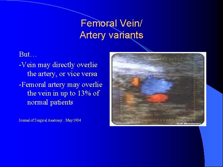 Femoral Vein/ Artery variants But… -Vein may directly overlie the artery, or vice versa