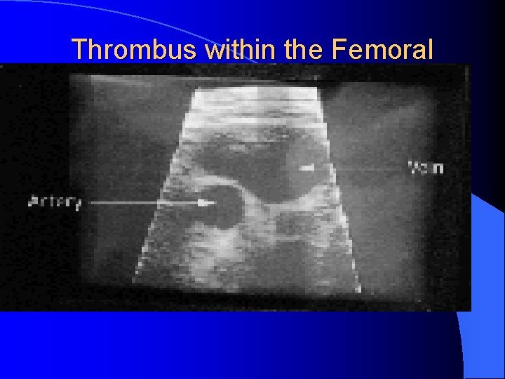Thrombus within the Femoral Vein 