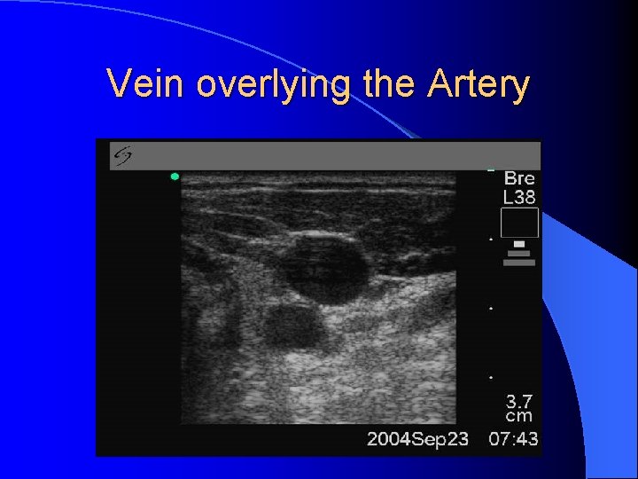 Vein overlying the Artery 