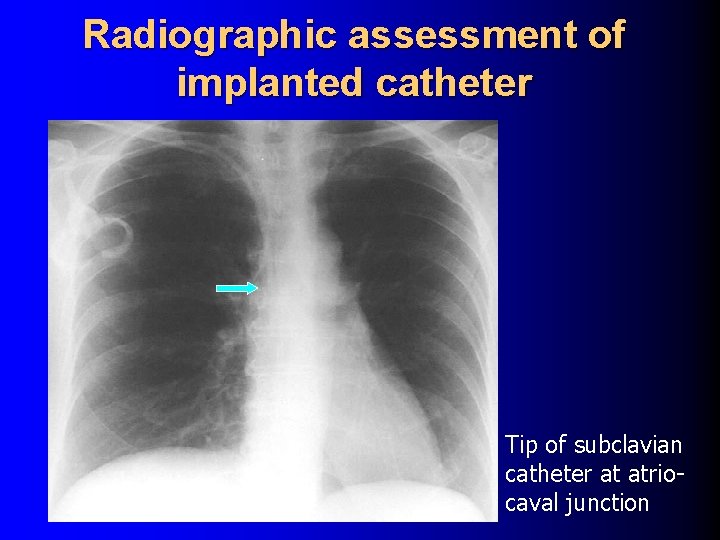 Radiographic assessment of implanted catheter Tip of subclavian catheter at atriocaval junction Radiographic assessment of implanted catheter Tip of subclavian catheter at atriocaval junction
