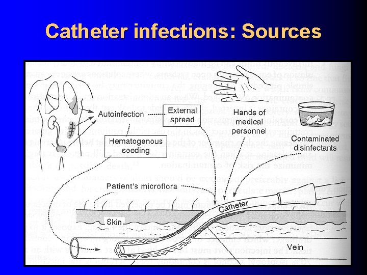 Catheter infections: Sources 