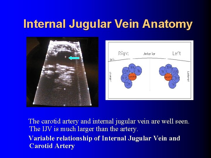 Internal Jugular Vein Anatomy The carotid artery and internal jugular vein are well seen. Internal Jugular Vein Anatomy The carotid artery and internal jugular vein are well seen.