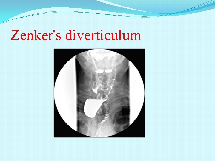 Zenker's diverticulum 