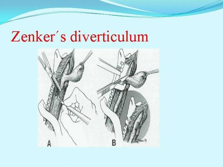 Zenker´s diverticulum 