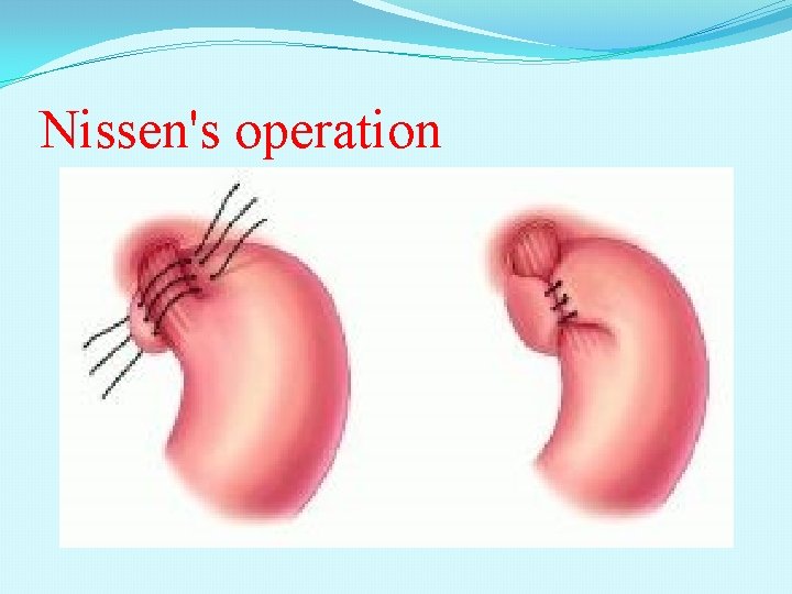 Nissen's operation 