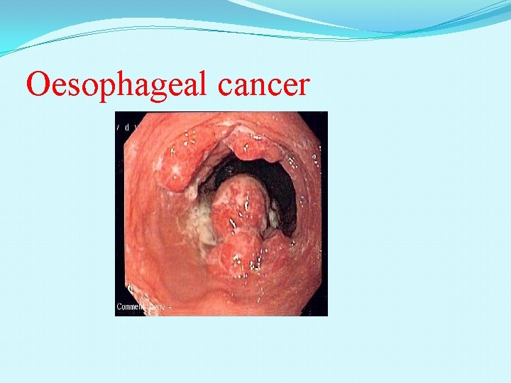 Oesophageal cancer 