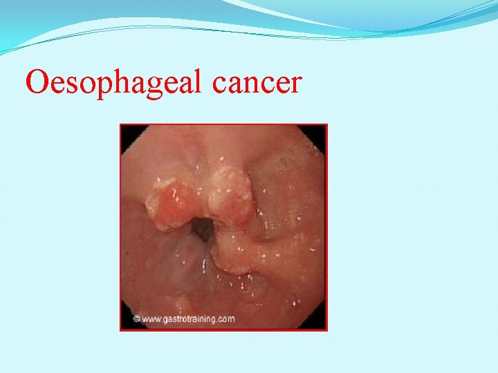 Oesophageal cancer 