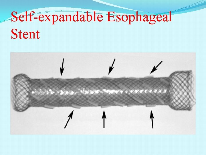 Self-expandable Esophageal Stent 