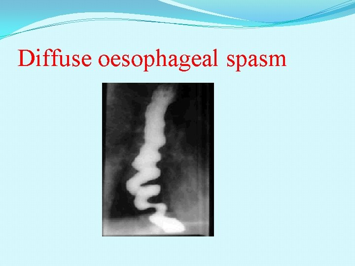 Diffuse oesophageal spasm 