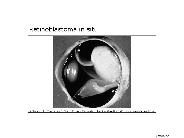 Retinoblastoma in situ © 2005 Elsevier Retinoblastoma in situ © 2005 Elsevier