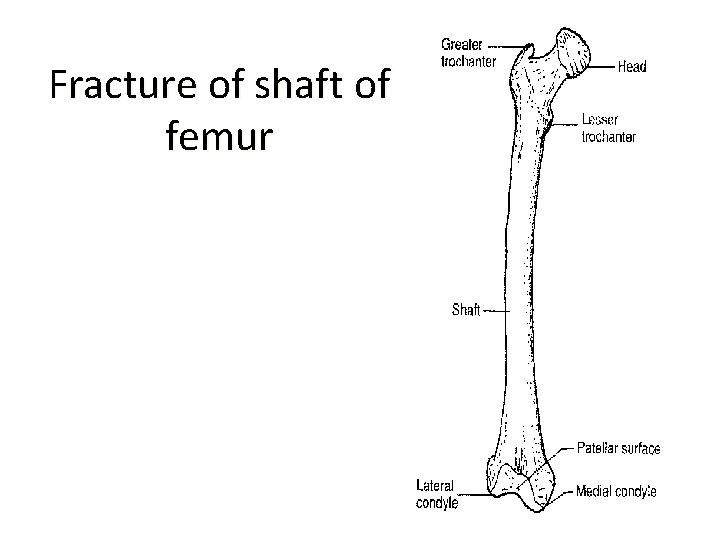 Fracture of shaft of femur 
