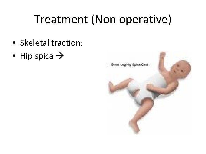 Treatment (Non operative) • Skeletal traction: • Hip spica 