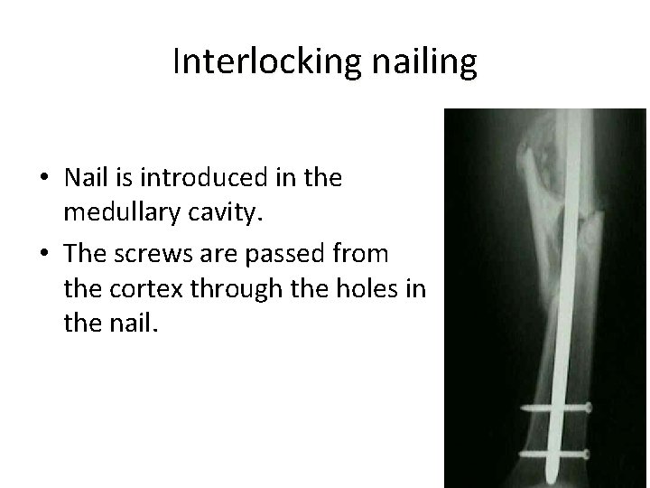Interlocking nailing • Nail is introduced in the medullary cavity. • The screws are