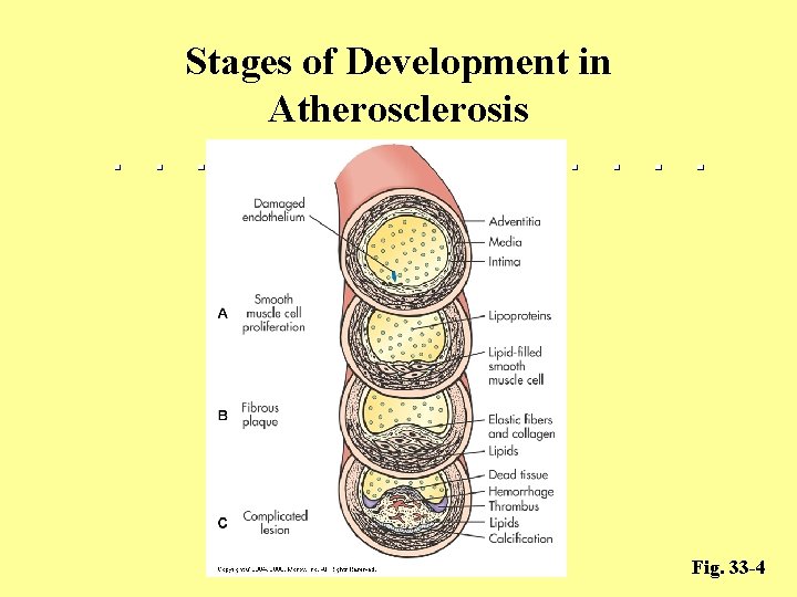 Stages of Development in Atherosclerosis Fig. 33 -4 