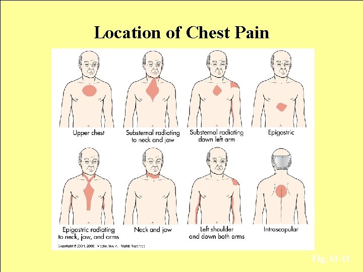 Location of Chest Pain Fig. 33 -12 
