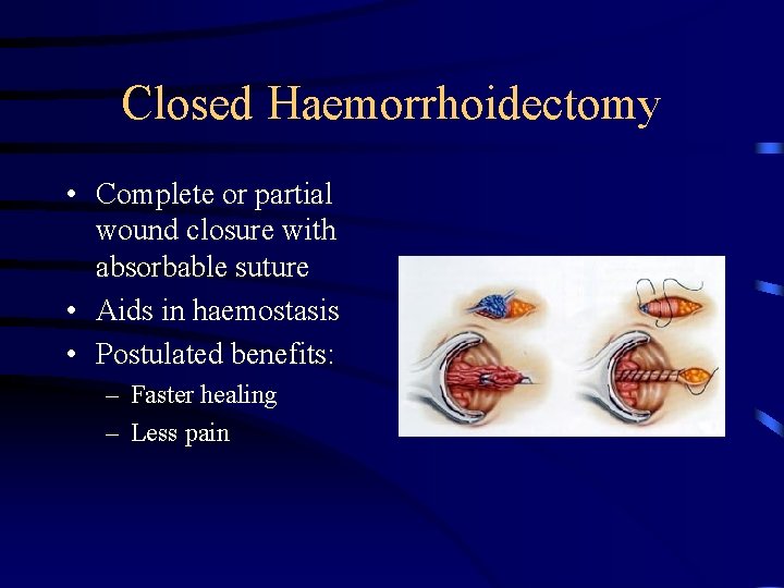 Closed Haemorrhoidectomy • Complete or partial wound closure with absorbable suture • Aids in