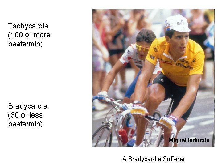 Tachycardia (100 or more beats/min) Bradycardia (60 or less beats/min) Miguel Indurain A Bradycardia