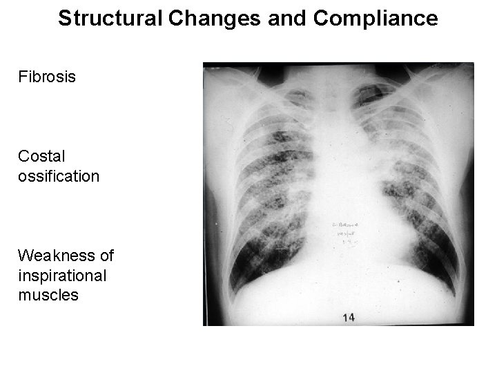 Structural Changes and Compliance Fibrosis Costal ossification Weakness of inspirational muscles 