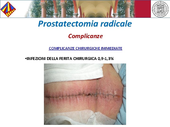 Prostatectomia radicale Complicanze COMPLICANZE CHIRURGICHE IMMEDIATE • INFEZIONI DELLA FERITA CHIRURGICA 0, 9 -1,