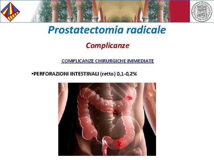 Prostatectomia radicale Complicanze COMPLICANZE CHIRURGICHE IMMEDIATE • PERFORAZIONI INTESTINALI (retto) 0, 1 -0, 2%