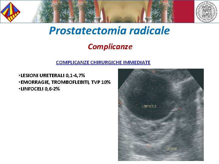 Prostatectomia radicale Complicanze COMPLICANZE CHIRURGICHE IMMEDIATE • LESIONI URETERALI 0, 1 -4, 7% •