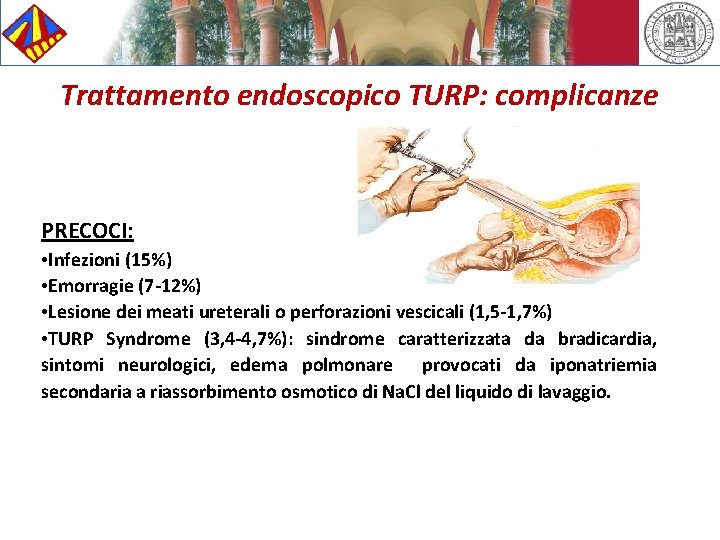 Trattamento endoscopico TURP: complicanze PRECOCI: • Infezioni (15%) • Emorragie (7 -12%) • Lesione