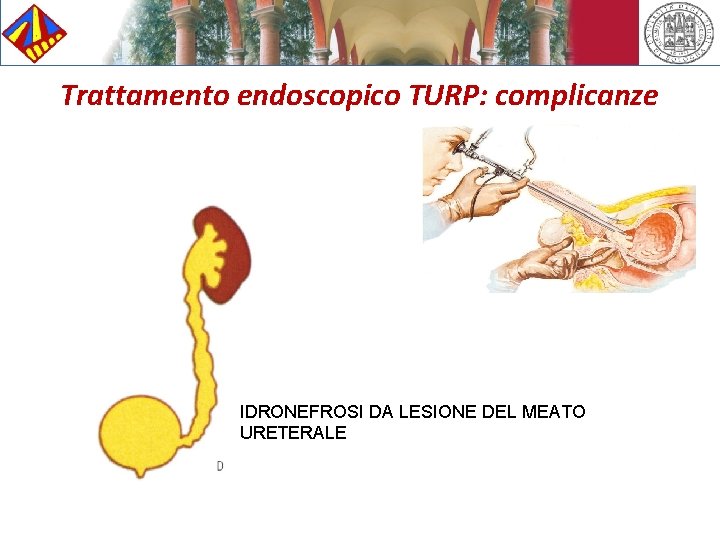 Trattamento endoscopico TURP: complicanze IDRONEFROSI DA LESIONE DEL MEATO URETERALE 