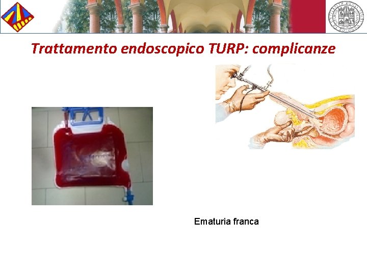 Trattamento endoscopico TURP: complicanze Ematuria franca 