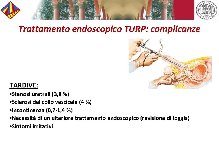 Trattamento endoscopico TURP: complicanze TARDIVE: • Stenosi uretrali (3, 8 %) • Sclerosi del