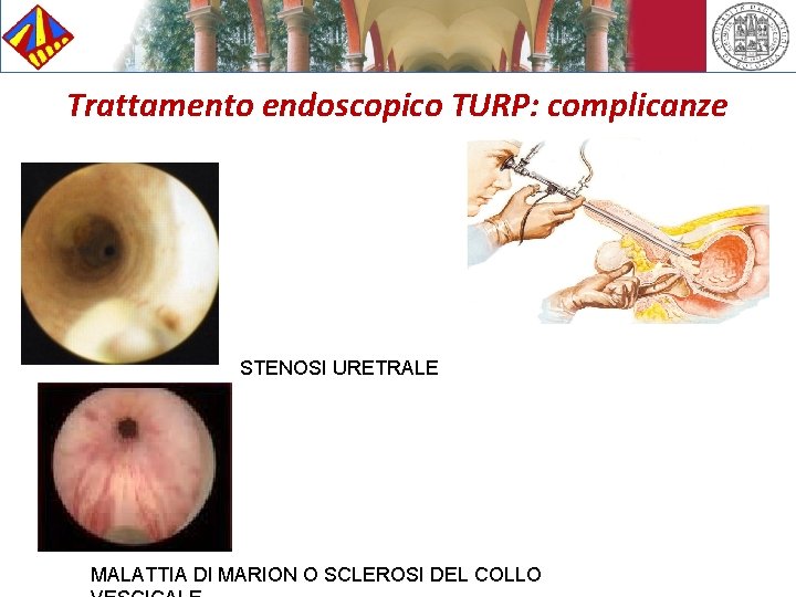 Trattamento endoscopico TURP: complicanze STENOSI URETRALE MALATTIA DI MARION O SCLEROSI DEL COLLO 
