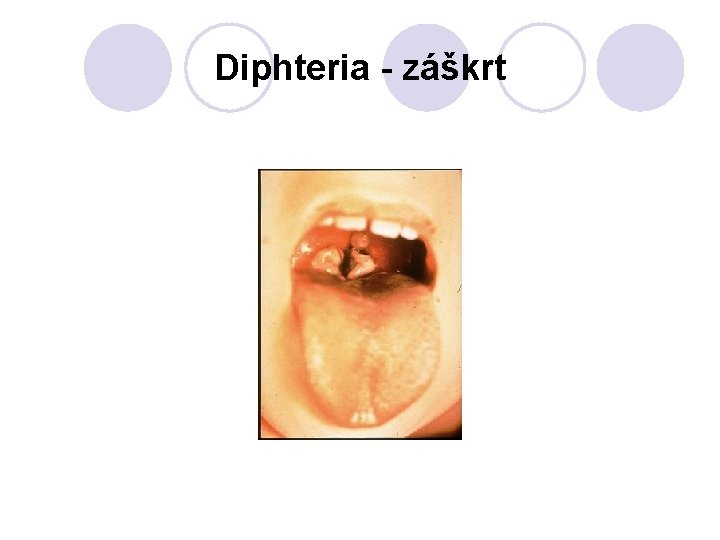 Diphteria - záškrt 