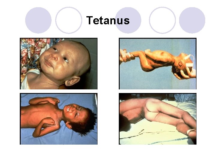 Tetanus 