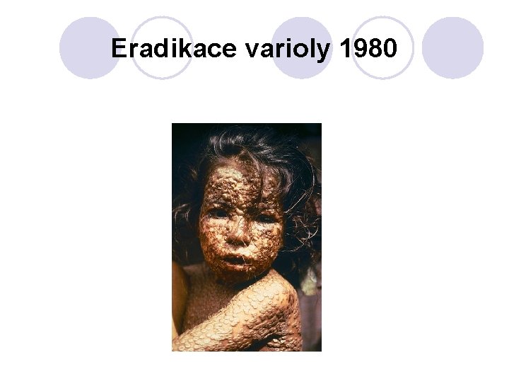 Eradikace varioly 1980 