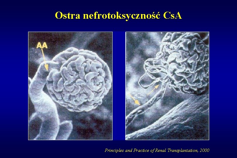 Ostra nefrotoksyczność Cs. A Principles and Practice of Renal Transplantation, 2000 