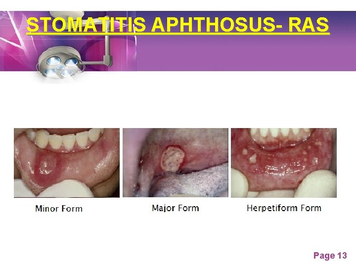 STOMATITIS APHTHOSUS- RAS Page 13 STOMATITIS APHTHOSUS- RAS Page 13