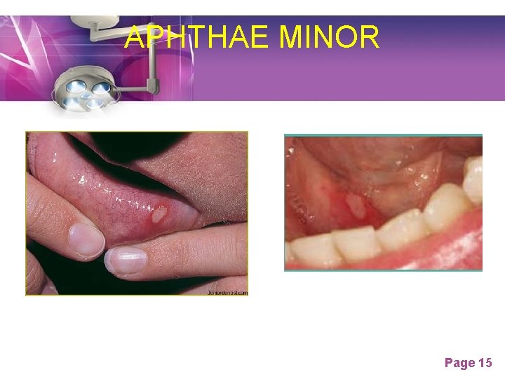 APHTHAE MINOR Page 15 APHTHAE MINOR Page 15