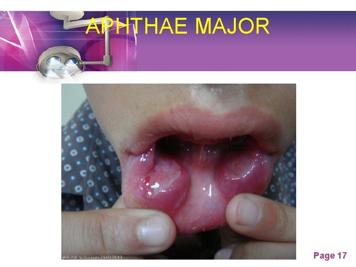 APHTHAE MAJOR Page 17 APHTHAE MAJOR Page 17