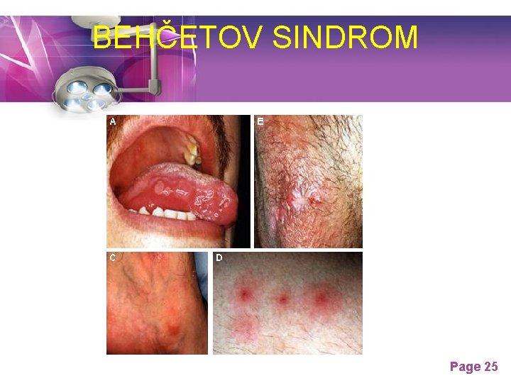 BEHČETOV SINDROM Page 25 BEHČETOV SINDROM Page 25