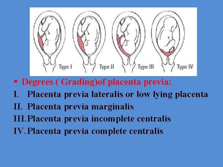 § Degrees ( Grading)of placenta previa: I. Placenta previa lateralis or low lying placenta