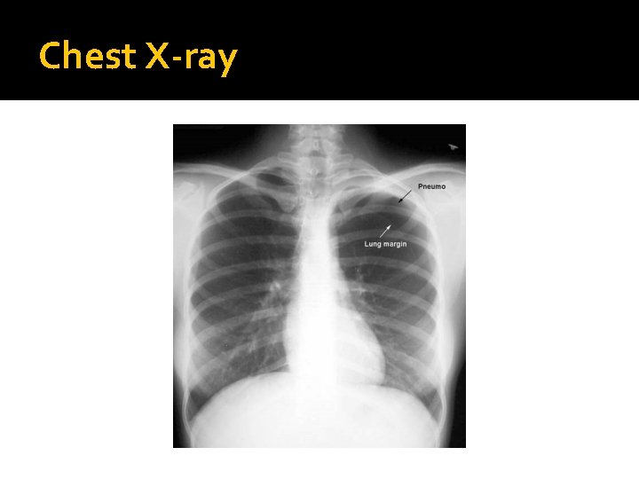 Chest X-ray 