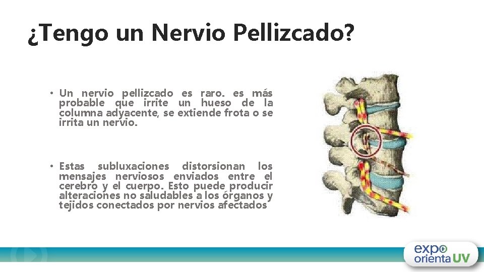 ¿Tengo un Nervio Pellizcado? • Un nervio pellizcado es raro. es más probable que