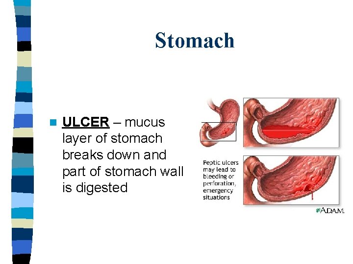 Stomach n ULCER – mucus layer of stomach breaks down and part of stomach