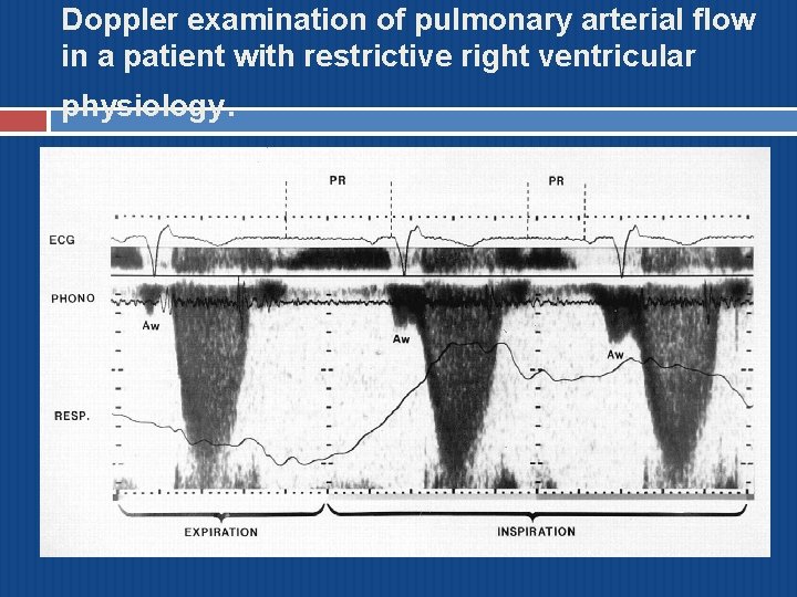 Doppler examination of pulmonary arterial flow in a patient with restrictive right ventricular physiology.