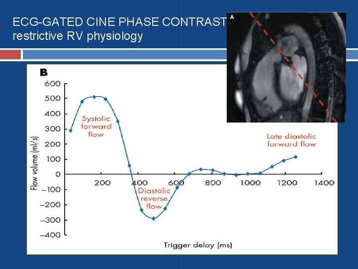 ECG-GATED CINE PHASE CONTRAST MR restrictive RV physiology 