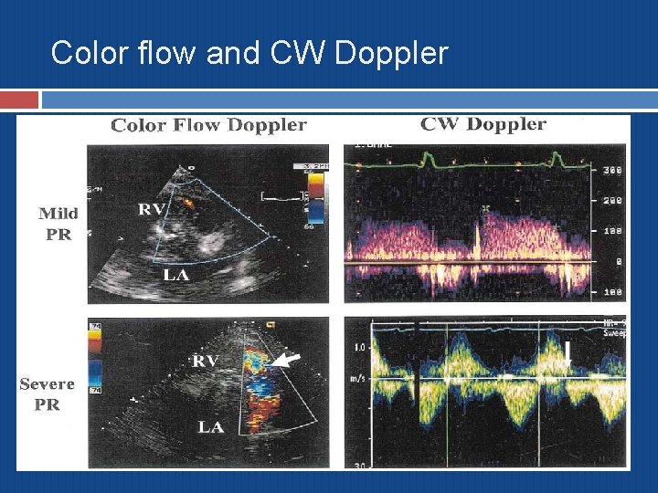 Color flow and CW Doppler 